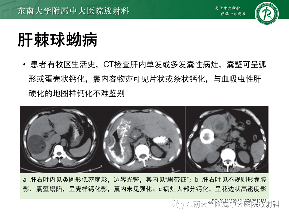 影像PPT - 【PPT】血吸虫肝病-36