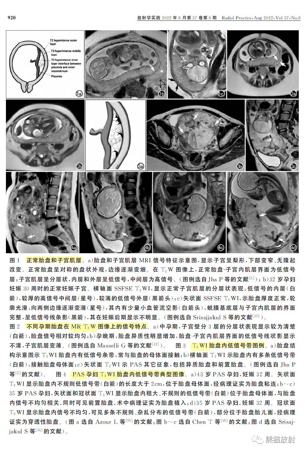 影像PPT - 植入性胎盘谱系疾病MRI检查规范、征象及临床病例解读-4 影像PPT - 植入性胎盘谱系疾病MRI检查规范、征象及临床病例解读-4