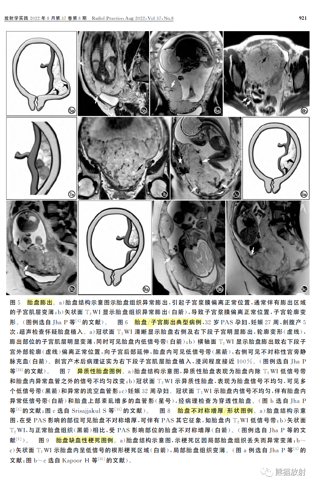 影像PPT - 植入性胎盘谱系疾病MRI检查规范、征象及临床病例解读-5 影像PPT - 植入性胎盘谱系疾病MRI检查规范、征象及临床病例解读-5