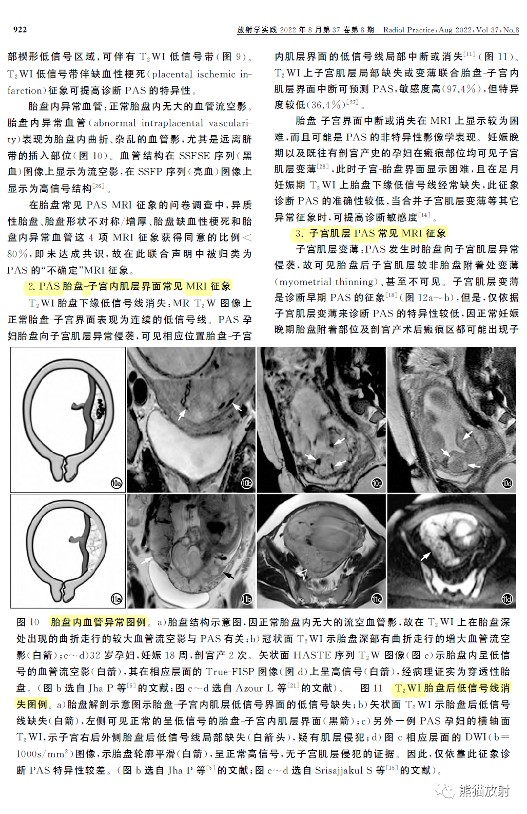 影像PPT - 植入性胎盘谱系疾病MRI检查规范、征象及临床病例解读-6 影像PPT - 植入性胎盘谱系疾病MRI检查规范、征象及临床病例解读-6