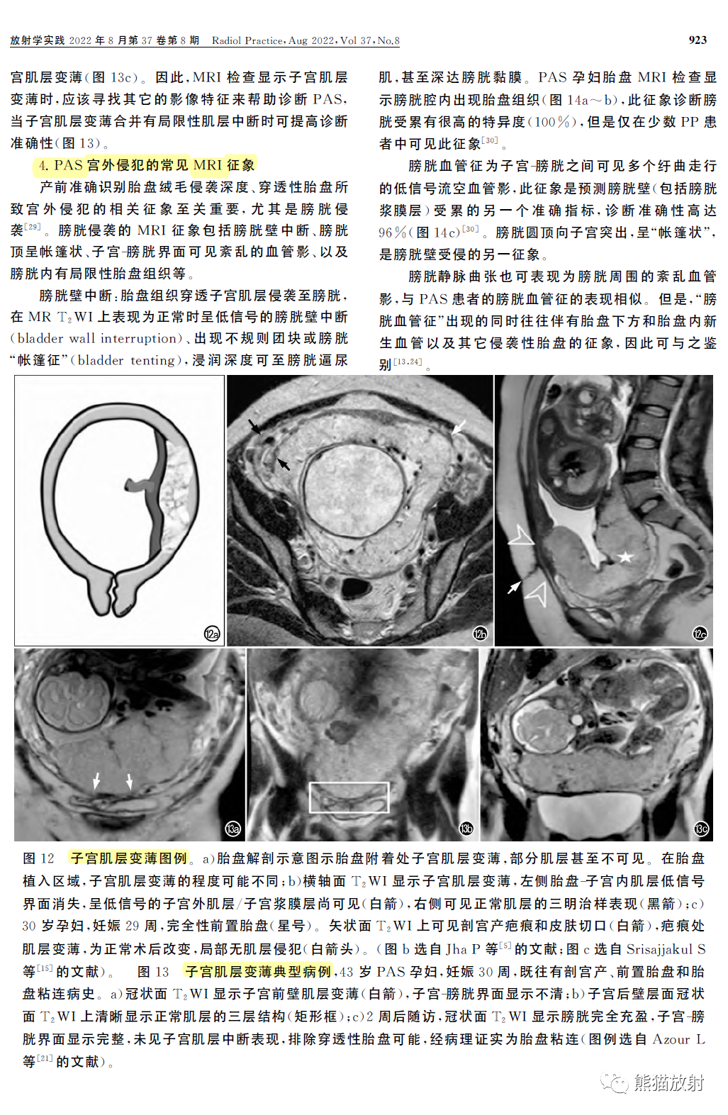 影像PPT - 植入性胎盘谱系疾病MRI检查规范、征象及临床病例解读-7 影像PPT - 植入性胎盘谱系疾病MRI检查规范、征象及临床病例解读-7