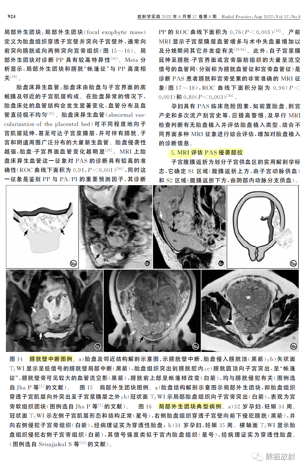 影像PPT - 植入性胎盘谱系疾病MRI检查规范、征象及临床病例解读-8 影像PPT - 植入性胎盘谱系疾病MRI检查规范、征象及临床病例解读-8