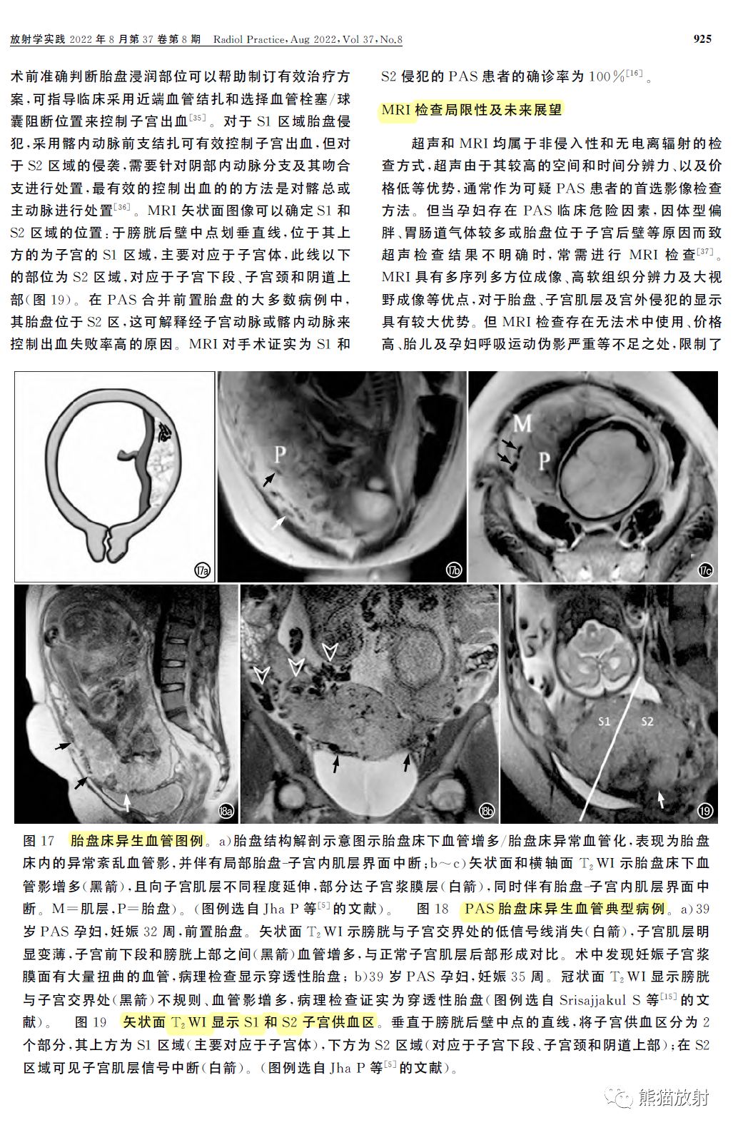 影像PPT - 植入性胎盘谱系疾病MRI检查规范、征象及临床病例解读-9 影像PPT - 植入性胎盘谱系疾病MRI检查规范、征象及临床病例解读-9