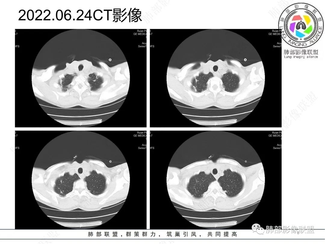 影像PPT - 【病例】肺曲霉菌病1例CT影像-8 影像PPT - 【病例】肺曲霉菌病1例CT影像-8