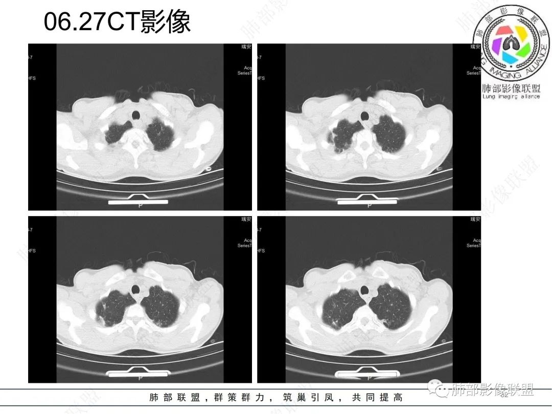 影像PPT - 【病例】肺曲霉菌病1例CT影像-32 影像PPT - 【病例】肺曲霉菌病1例CT影像-32