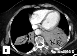 影像PPT - 【病例】两例女性肺黏膜相关淋巴组织淋巴瘤及相关文献复习-5 影像PPT - 【病例】两例女性肺黏膜相关淋巴组织淋巴瘤及相关文献复习-5
