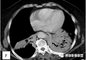影像PPT - 【病例】两例女性肺黏膜相关淋巴组织淋巴瘤及相关文献复习-6 影像PPT - 【病例】两例女性肺黏膜相关淋巴组织淋巴瘤及相关文献复习-6