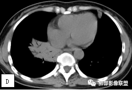 影像PPT - 【病例】两例女性肺黏膜相关淋巴组织淋巴瘤及相关文献复习-11 影像PPT - 【病例】两例女性肺黏膜相关淋巴组织淋巴瘤及相关文献复习-11