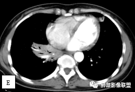 影像PPT - 【病例】两例女性肺黏膜相关淋巴组织淋巴瘤及相关文献复习-12 影像PPT - 【病例】两例女性肺黏膜相关淋巴组织淋巴瘤及相关文献复习-12
