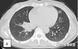影像PPT - 【病例】两例女性肺黏膜相关淋巴组织淋巴瘤及相关文献复习-8 影像PPT - 【病例】两例女性肺黏膜相关淋巴组织淋巴瘤及相关文献复习-8
