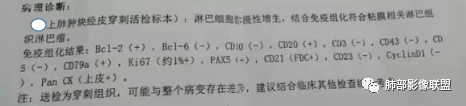 影像PPT - 【病例】两例女性肺黏膜相关淋巴组织淋巴瘤及相关文献复习-14 影像PPT - 【病例】两例女性肺黏膜相关淋巴组织淋巴瘤及相关文献复习-14