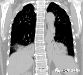 影像PPT - 【病例】两例女性肺黏膜相关淋巴组织淋巴瘤及相关文献复习-15 影像PPT - 【病例】两例女性肺黏膜相关淋巴组织淋巴瘤及相关文献复习-15