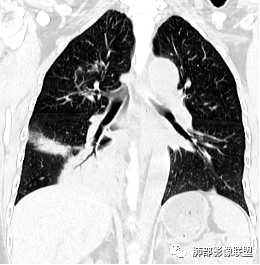 影像PPT - 【病例】两例女性肺黏膜相关淋巴组织淋巴瘤及相关文献复习-16 影像PPT - 【病例】两例女性肺黏膜相关淋巴组织淋巴瘤及相关文献复习-16