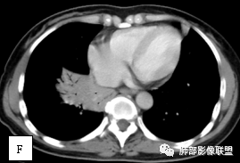 影像PPT - 【病例】两例女性肺黏膜相关淋巴组织淋巴瘤及相关文献复习-13 影像PPT - 【病例】两例女性肺黏膜相关淋巴组织淋巴瘤及相关文献复习-13