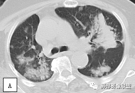 影像PPT - 【病例】两例女性肺黏膜相关淋巴组织淋巴瘤及相关文献复习-19