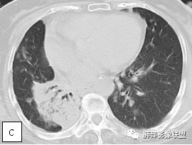 影像PPT - 【病例】两例女性肺黏膜相关淋巴组织淋巴瘤及相关文献复习-21 影像PPT - 【病例】两例女性肺黏膜相关淋巴组织淋巴瘤及相关文献复习-21