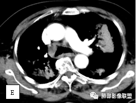 影像PPT - 【病例】两例女性肺黏膜相关淋巴组织淋巴瘤及相关文献复习-23 影像PPT - 【病例】两例女性肺黏膜相关淋巴组织淋巴瘤及相关文献复习-23