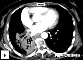 影像PPT - 【病例】两例女性肺黏膜相关淋巴组织淋巴瘤及相关文献复习-24 影像PPT - 【病例】两例女性肺黏膜相关淋巴组织淋巴瘤及相关文献复习-24