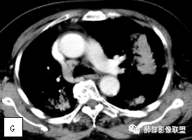 影像PPT - 【病例】两例女性肺黏膜相关淋巴组织淋巴瘤及相关文献复习-25 影像PPT - 【病例】两例女性肺黏膜相关淋巴组织淋巴瘤及相关文献复习-25