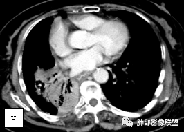影像PPT - 【病例】两例女性肺黏膜相关淋巴组织淋巴瘤及相关文献复习-26 影像PPT - 【病例】两例女性肺黏膜相关淋巴组织淋巴瘤及相关文献复习-26