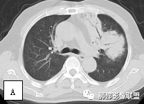 影像PPT - 【病例】两例女性肺黏膜相关淋巴组织淋巴瘤及相关文献复习-27 影像PPT - 【病例】两例女性肺黏膜相关淋巴组织淋巴瘤及相关文献复习-27