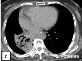 影像PPT - 【病例】两例女性肺黏膜相关淋巴组织淋巴瘤及相关文献复习-22 影像PPT - 【病例】两例女性肺黏膜相关淋巴组织淋巴瘤及相关文献复习-22
