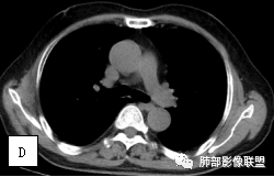影像PPT - 【病例】两例女性肺黏膜相关淋巴组织淋巴瘤及相关文献复习-30 影像PPT - 【病例】两例女性肺黏膜相关淋巴组织淋巴瘤及相关文献复习-30