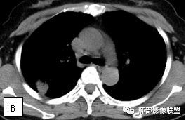 影像PPT - 【病例】两例女性肺黏膜相关淋巴组织淋巴瘤及相关文献复习-32 影像PPT - 【病例】两例女性肺黏膜相关淋巴组织淋巴瘤及相关文献复习-32