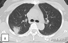 影像PPT - 【病例】两例女性肺黏膜相关淋巴组织淋巴瘤及相关文献复习-31 影像PPT - 【病例】两例女性肺黏膜相关淋巴组织淋巴瘤及相关文献复习-31