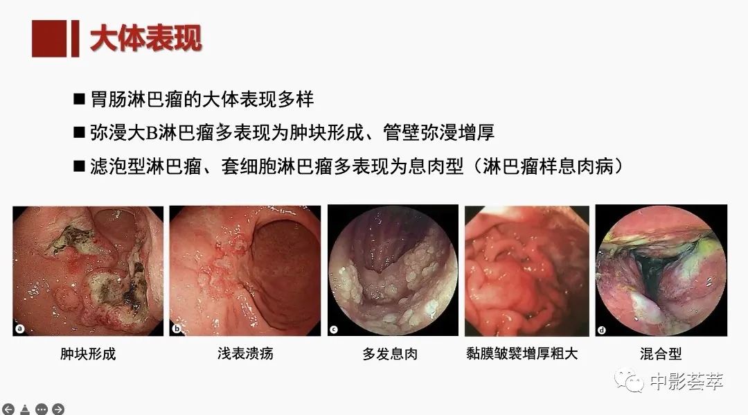 影像PPT - 【PPT】胃肠淋巴瘤及小肠肿瘤性的病变综述-7