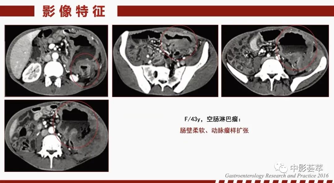 影像PPT - 【PPT】胃肠淋巴瘤及小肠肿瘤性的病变综述-10