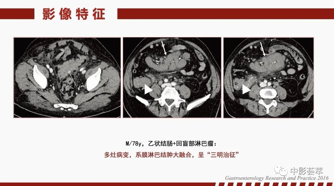 影像PPT - 【PPT】胃肠淋巴瘤及小肠肿瘤性的病变综述-12
