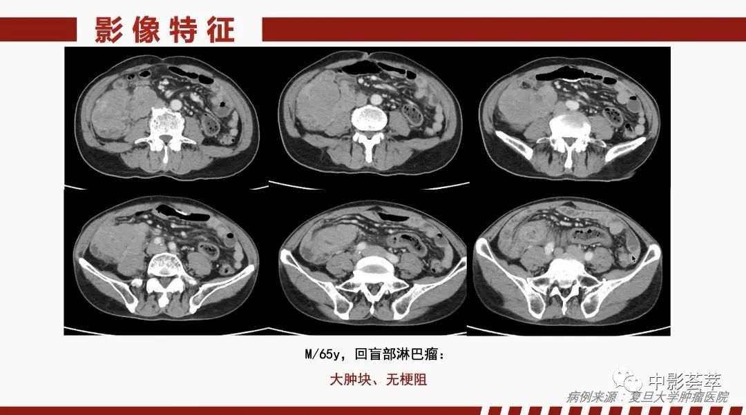 影像PPT - 【PPT】胃肠淋巴瘤及小肠肿瘤性的病变综述-13