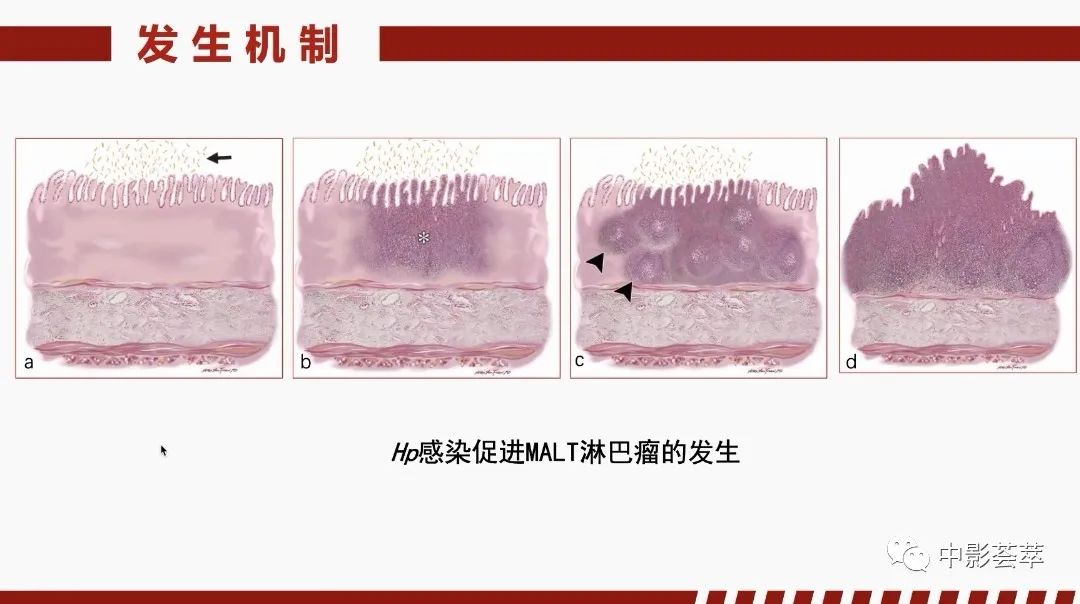 影像PPT - 【PPT】胃肠淋巴瘤及小肠肿瘤性的病变综述-16