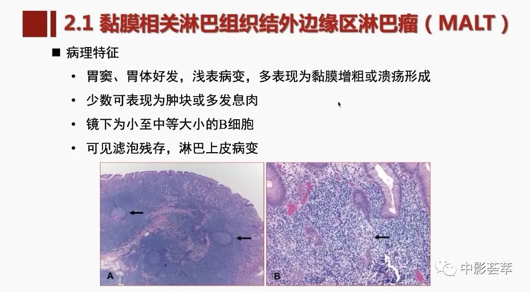 影像PPT - 【PPT】胃肠淋巴瘤及小肠肿瘤性的病变综述-18