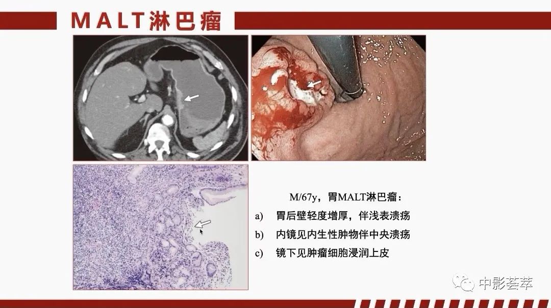 影像PPT - 【PPT】胃肠淋巴瘤及小肠肿瘤性的病变综述-20