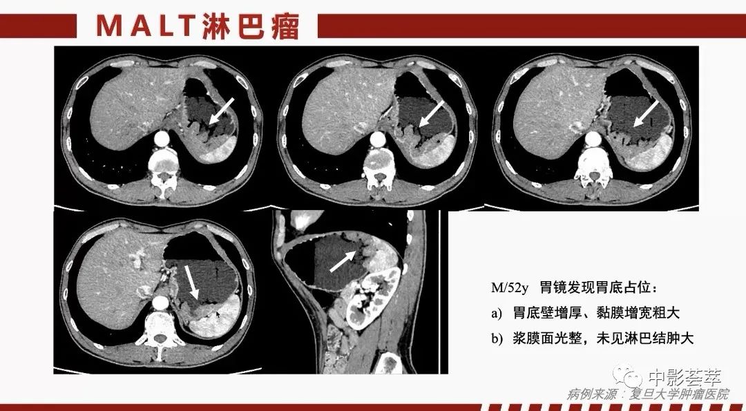 影像PPT - 【PPT】胃肠淋巴瘤及小肠肿瘤性的病变综述-21
