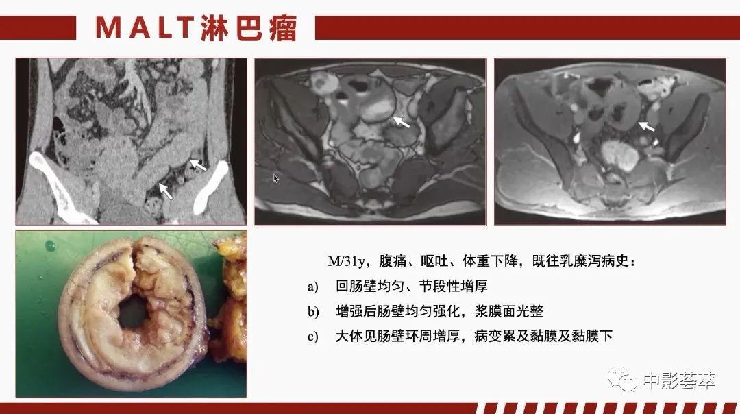 影像PPT - 【PPT】胃肠淋巴瘤及小肠肿瘤性的病变综述-22