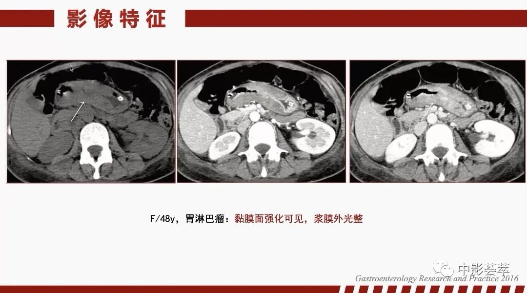 影像PPT - 【PPT】胃肠淋巴瘤及小肠肿瘤性的病变综述-11