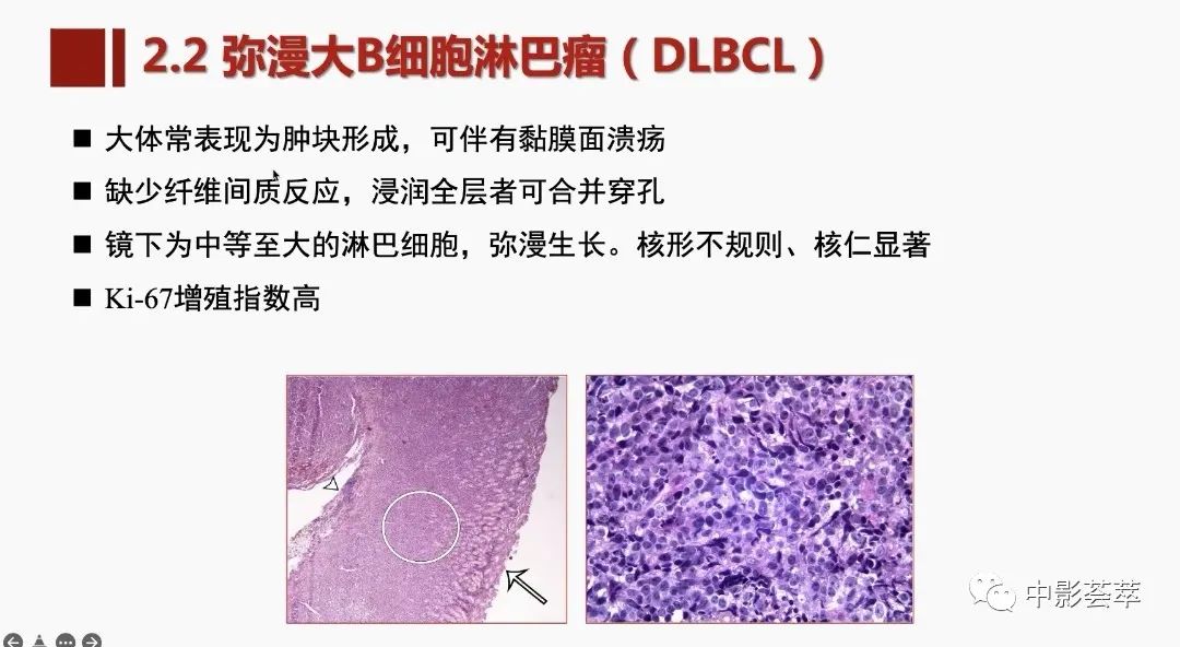 影像PPT - 【PPT】胃肠淋巴瘤及小肠肿瘤性的病变综述-24