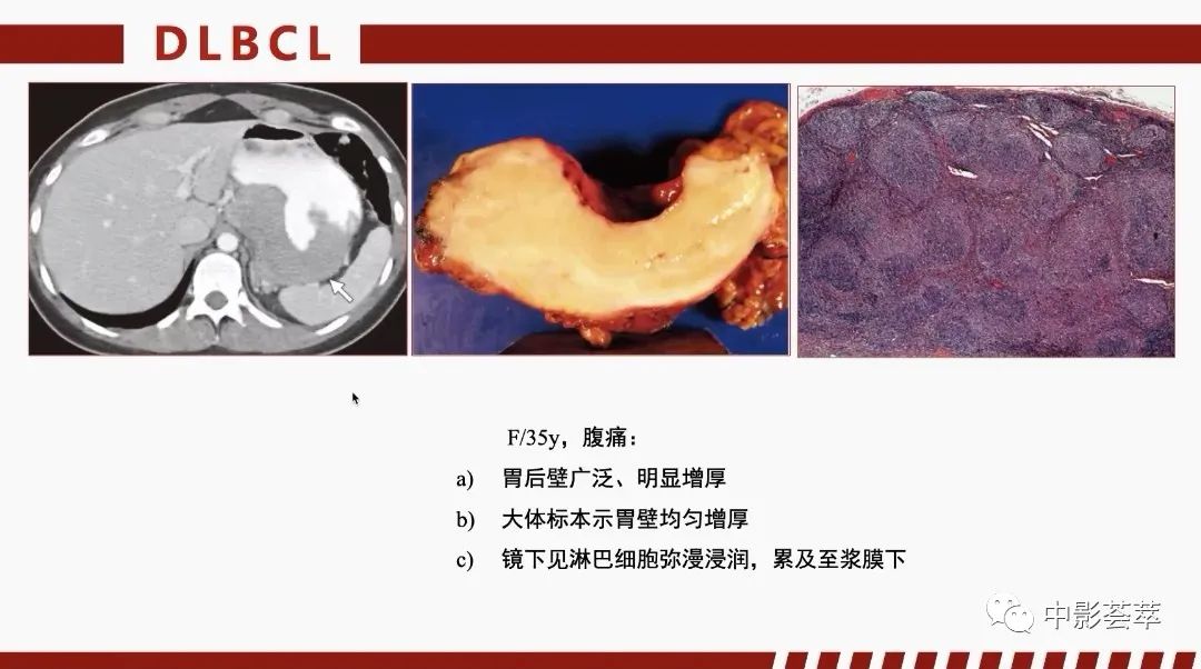 影像PPT - 【PPT】胃肠淋巴瘤及小肠肿瘤性的病变综述-27