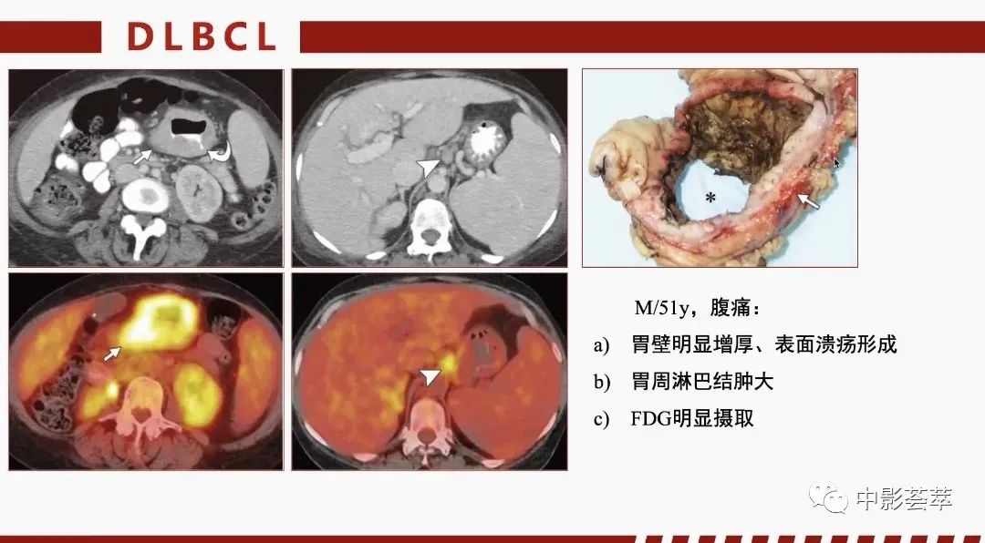 影像PPT - 【PPT】胃肠淋巴瘤及小肠肿瘤性的病变综述-28
