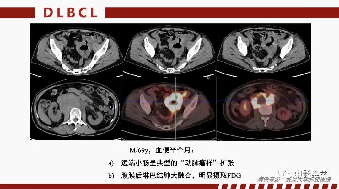 影像PPT - 【PPT】胃肠淋巴瘤及小肠肿瘤性的病变综述-29