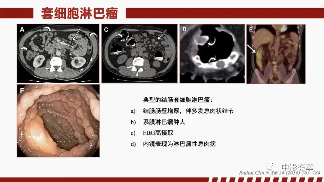 影像PPT - 【PPT】胃肠淋巴瘤及小肠肿瘤性的病变综述-33