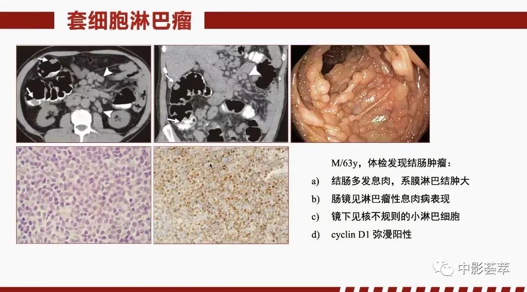 影像PPT - 【PPT】胃肠淋巴瘤及小肠肿瘤性的病变综述-32