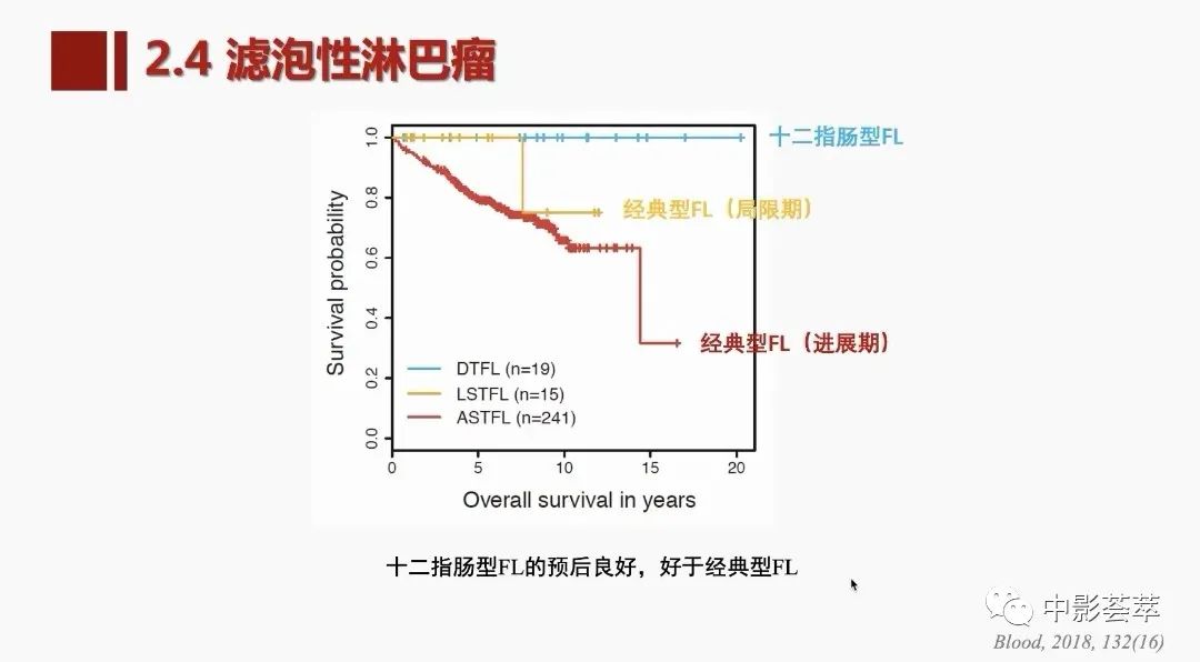 影像PPT - 【PPT】胃肠淋巴瘤及小肠肿瘤性的病变综述-35