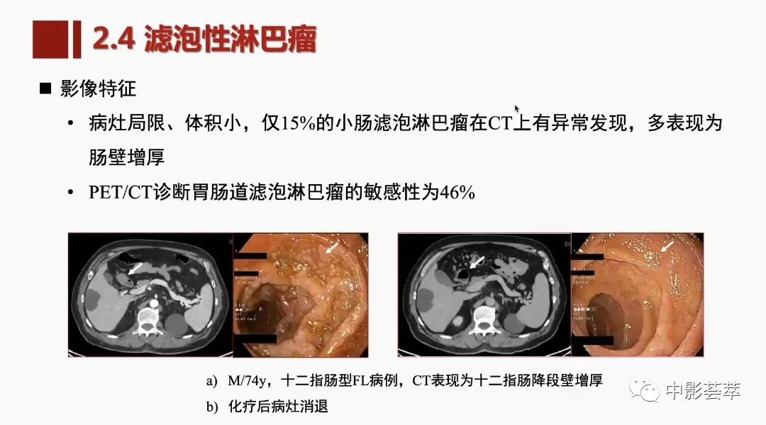 影像PPT - 【PPT】胃肠淋巴瘤及小肠肿瘤性的病变综述-36