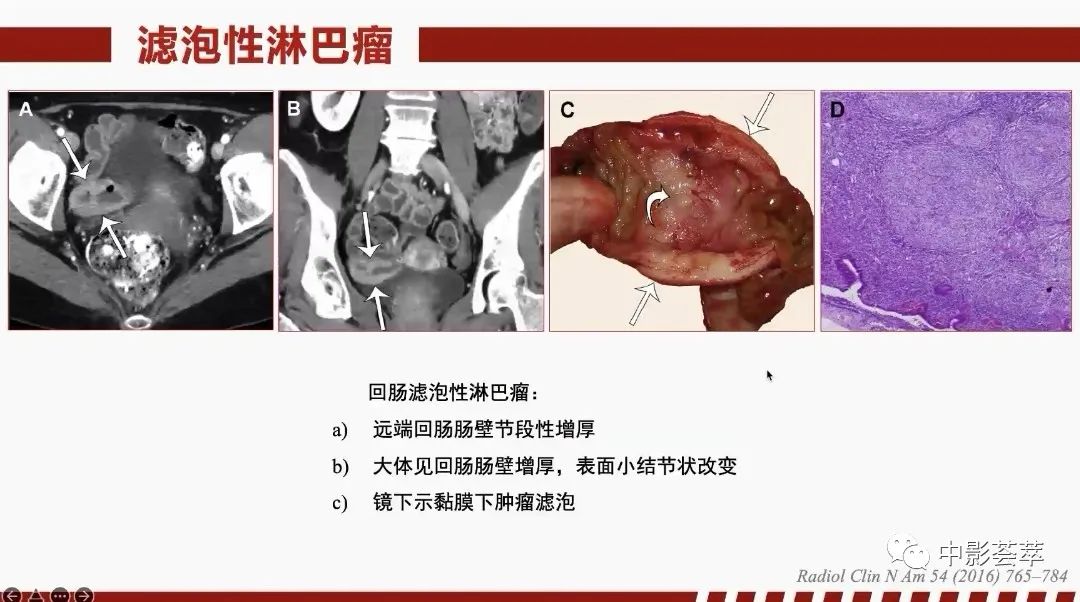 影像PPT - 【PPT】胃肠淋巴瘤及小肠肿瘤性的病变综述-37