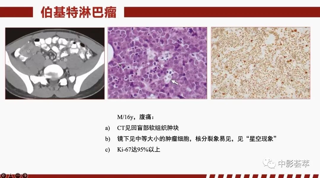 影像PPT - 【PPT】胃肠淋巴瘤及小肠肿瘤性的病变综述-40