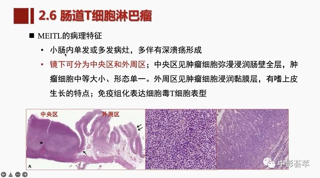 影像PPT - 【PPT】胃肠淋巴瘤及小肠肿瘤性的病变综述-44